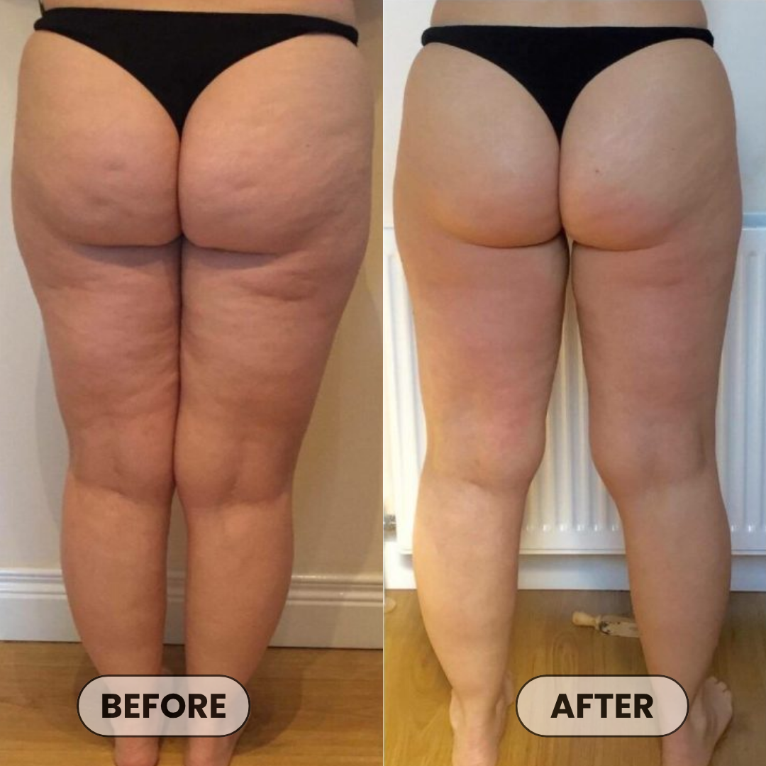 Anti-Cellulite Massage Oil