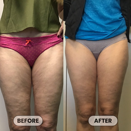 Anti-Cellulite Massage Oil